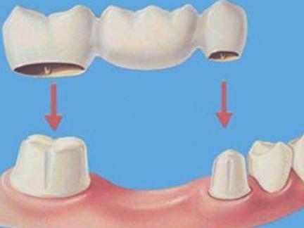 补一颗烤瓷牙多少钱?价格受哪些因素影响?