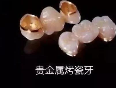 成都烤瓷牙价格多少钱?费用大概是多少来看介绍!