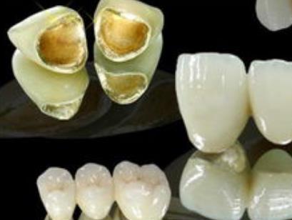 金钯烤瓷牙价格多少钱?阐述几大优点!
