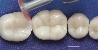 去医院补牙要多少钱?受什么因素影响具体了解?