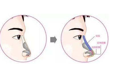 隆鼻手术的价格受哪些影响?具体介绍