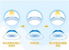 近视矫正都有哪些方法？带来阐述了解近视调节详情