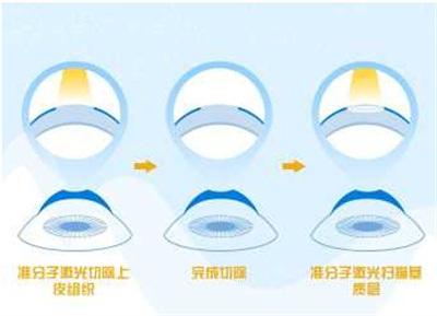 近视矫正都有哪些方法？带来阐述了解近视调节详情