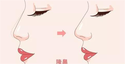 隆鼻手术的价格是多少？不会可以接受吗？