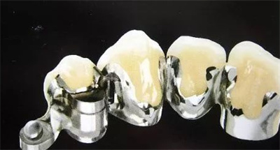 上海钴铬烤瓷牙价格多少钱?认清牙齿情况