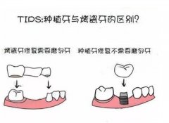 上海种植牙价格受哪些因素影响一一来认识？