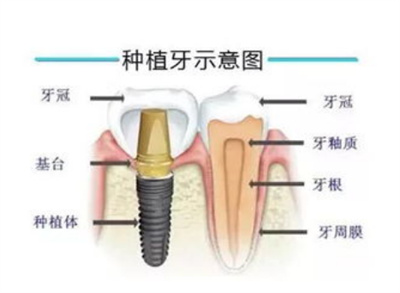 上海种植牙价格受哪些因素影响一一来认识？