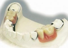 钛合金义齿价格多少钱？具有哪些优势？
