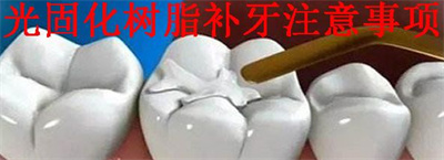 光固化树脂补牙价格，具体因素带来阐述！