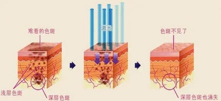 北京大学第三医院激光美容怎么样？真的能够去干净吗？告诉你事实的真相！