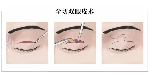 北京大学第一医院割双眼皮多少钱?医生信息_案例咨询一次了解清楚~