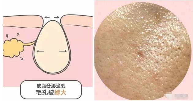 怎么收缩脸部毛孔?毛孔粗大怎么办?这几项轻医美教你重拾细腻肌肤!