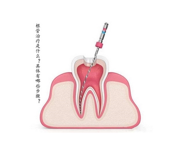 根管调节的步骤过程是怎么样的?医生调节过程分享~费用标准公开啦!