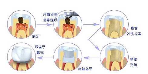 根管调节的步骤过程是怎么样的?医生调节过程分享~费用标准公开啦!