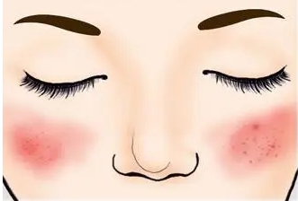 激光能去红血丝吗?红血丝是由什么原因引起的?注意事项又有哪些呢?