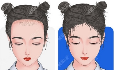 北医三院植发价格是多少？套路少果好，不要做秃头小仙女啦！