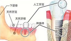 北京大学人民医院种植牙价格是多少?使用寿命有多久?种牙不盲目,医生来帮你!