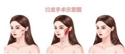 北京医院拉皮手术多少钱！技术好吗？价格大起底，看费用详情~
