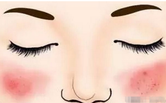 脸上红血丝怎么治？这几个技巧用处很大！日常修复，无瑕肌肤不是梦！