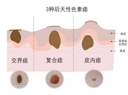 激光去痣大概多少钱？去的干净吗？激光的选择也很重要，快来看看！