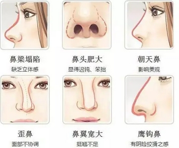 北大医院隆鼻多少钱?整形费用一览无余!揭秘隆鼻价格~