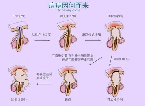 怎么样祛痘疤？这个去痘疤方法好简单！快来试一下吧！