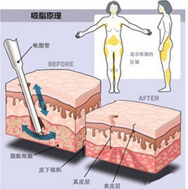 北大医院抽脂怎么样？技术好不好？真实案例看看果如何？