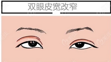 北京医院赵红艺双眼皮做的好吗?专业医生为你分享,案例点评揭晓!