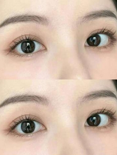 北京医院赵红艺双眼皮做的好吗?专业医生为你分享,案例点评揭晓!