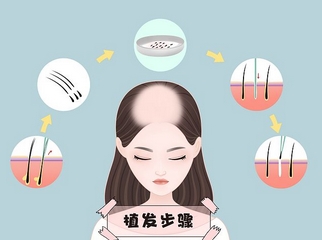 北京304医院植发中心介绍!除了选择医生还有哪些也很重要!植发指南get~