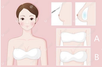 傲若拉假体价格多少钱?丰胸贵不贵?注意事项又有哪些呢?