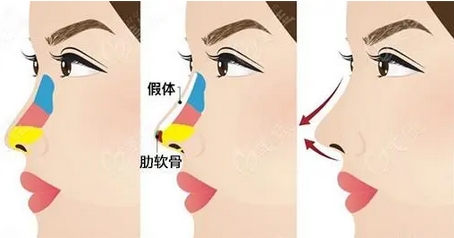 北京301医院做鼻子怎么样?自体脂肪-假体填充哪个好?相关技术介绍~
