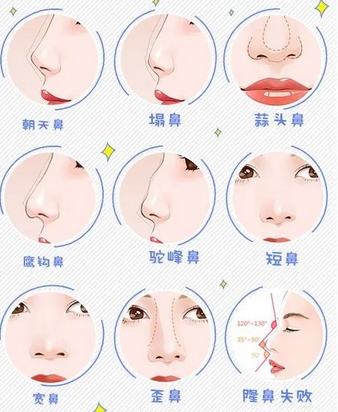 北京301医院做鼻子怎么样?自体脂肪-假体填充哪个好?相关技术介绍~