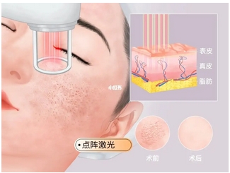 厦门长庚医院点阵激光如何?几次可以看到果吗?相关科室信息详细介绍~