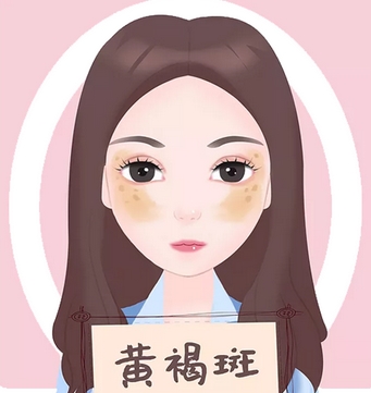 黄褐斑怎么去除果好?这几招帮你轻松祛除黄褐斑!去后需要注意哪些?
