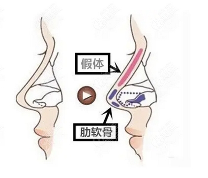 肋软骨隆鼻的优势有哪些?隆鼻过程记录分享!又要注意哪些呢?