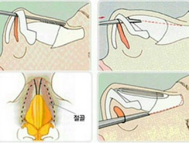 北京世纪坛医院整形美容外科驼峰鼻矫正价格是多少?实力专家贴心科普!附价格公开~