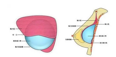 娜高假体隆胸多少钱?娜高假体隆胸的材料优势有哪些?美波指南~