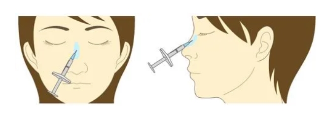 玻尿酸注射隆鼻效果如何？打完之几天可以恢复自然？可以维持多长时间呢？