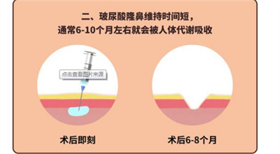 注射玻尿酸的副作用有哪些？玻尿酸适用人群有哪些？