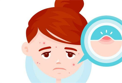 微针痘坑调节的原理及效果怎么样？微针痘坑调节后如何护理？