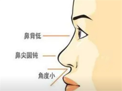 驼峰鼻整形费用是多少？术后要注意护理事项？
