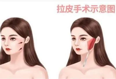 拉皮手术的副作用有哪些?拉皮手术效果怎么样?