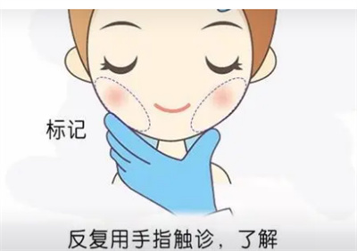 面部吸脂手术注意事项有哪些?面部吸脂手术效果如何?