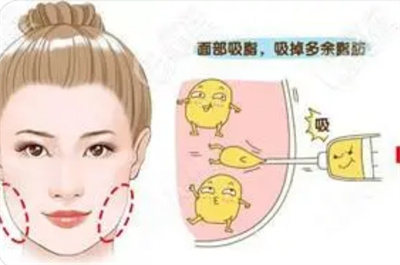 面部吸脂手术注意事项有哪些?面部吸脂手术效果如何?