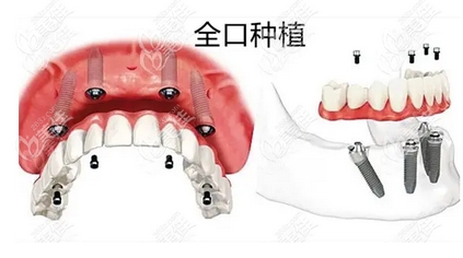 现在种一颗牙要多少钱?种植牙齿的费用受哪些因素的影响?快来点击收藏下来吧!