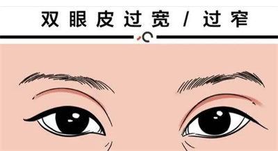 埋线双眼皮能保持多久?埋线双眼皮技术要求高吗?