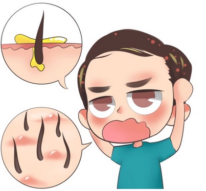 溢脂性脱发什么症状表现?脱发是因为什么呢?怎样可以去改良?