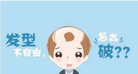溢脂性脱发什么症状表现?脱发是因为什么呢?怎样可以去改良?