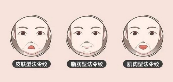 玻尿酸去法令纹多少钱?除了选择的玻尿酸材质不同,还有哪些影响因素呢?